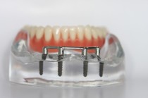 Zahnarztpraxis, Kaubrügge, Homburg, Implantate